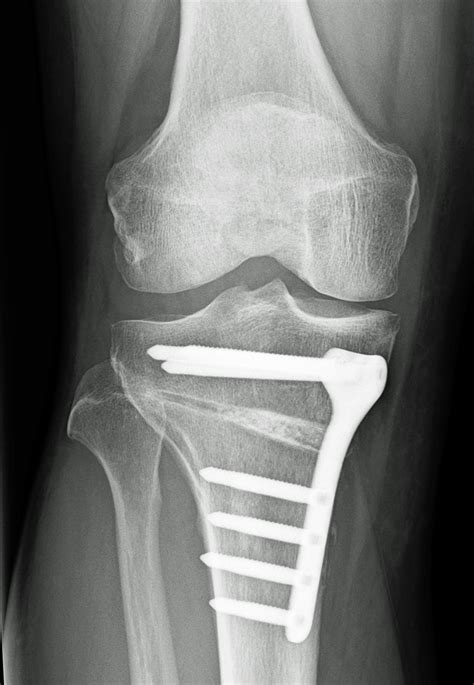 Osteotomy Orthosport Victoria
