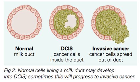 Ductal Carcinoma In Situ Dcis Fact Sheet Westmead Bci