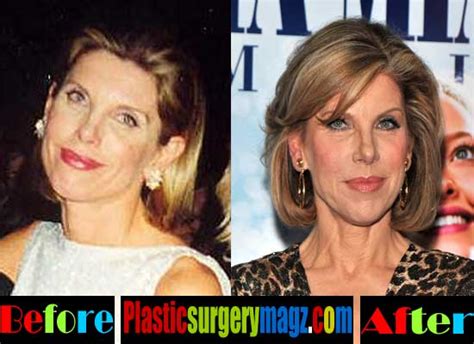 Christine Baranski Plastic Surgery Before And After Plastic Surgery