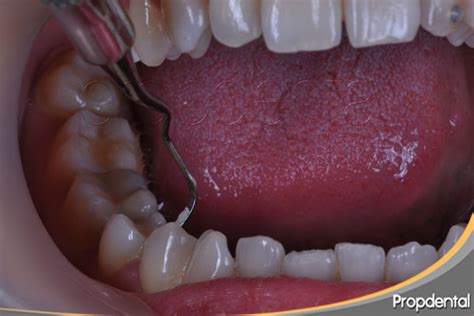 Enfermedad Periodontal Tratamiento Periodontitis Con Curetajes Dentales