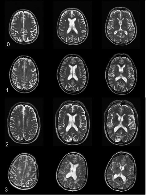 Neuroimaging In Dementia A Practical Guide Practical Neurology