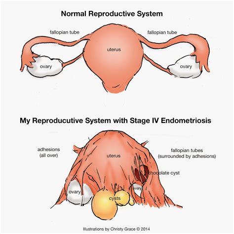 Endometriosis and adenomyosis are similar but separate conditions. Art of Christy Grace: Endometriosis