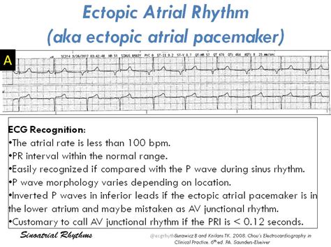 Ectopic Atrial Rhythm • The Atrial Rate Is Less Than Grepmed