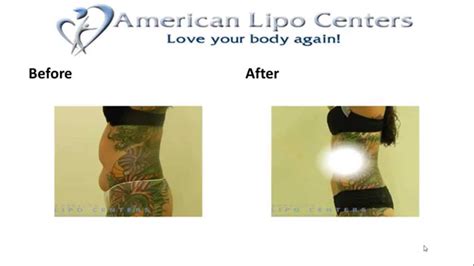Liposuction Atlanta Ga Before And After Laser Lipo Surgery Youtube