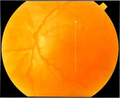 Operculum Retina Visual Acuity Alpf Medical Research