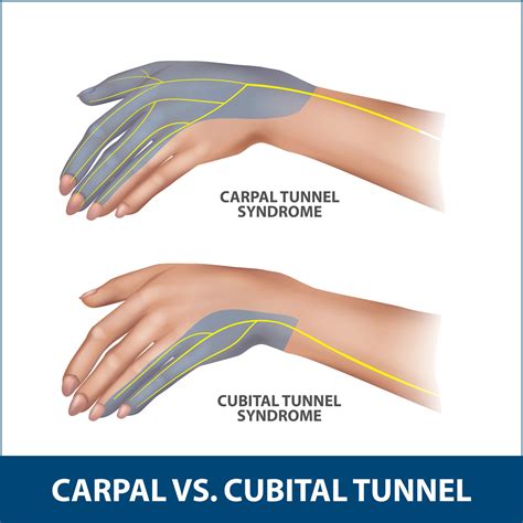 Orthopaedic Trauma Surgeon Elbow Cubital Tunnel Syndr