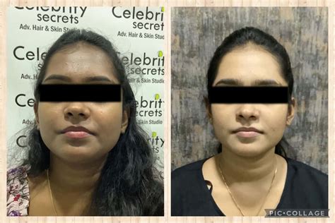 Glutathione Skin Whitening Hair Treatment Before After Results