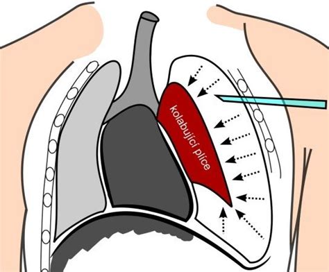 Pneumothorax Management By Chest Tube Download Scientific Diagram