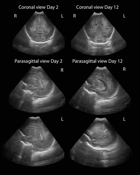 Cerebral Ultrasound Imaging Showing Increased Periventricular