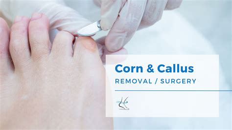 Foot Corn Removal By Cosmetic Podiatrist Moore Foot And Ankle Specialists