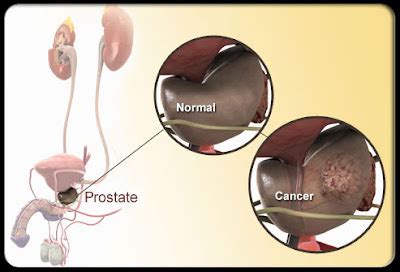 HEALTH DISEASE Prostate Cancer Pictures Slideshow Visual Guidelines To Symptoms Tests And