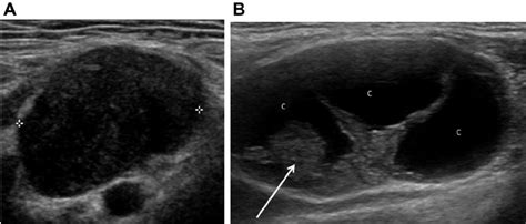 Ultrasonogram Characteristics A Abnormal Cervical Lymph Node