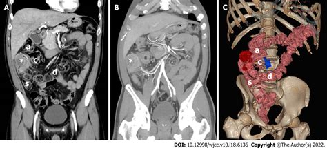 Carcinoma Located In A Right Sided Sigmoid Colon A Case Report