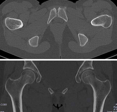 Pelvic Ct Scan