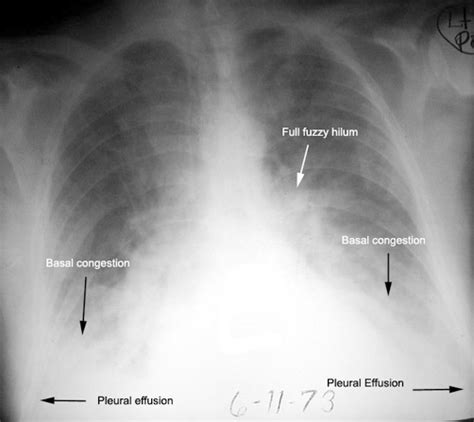 What Are The Findings Of Heart Failure Seen In This Chest X Ray