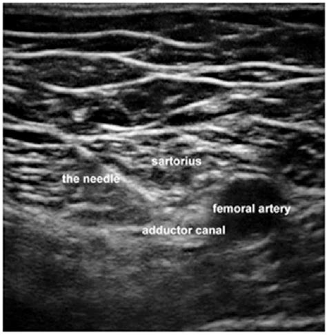 Ultrasound Image Of The Adductor Canal And Puncturing Needle