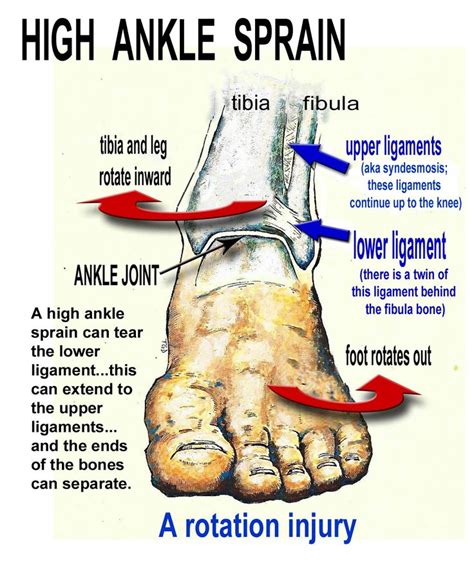 Ankle Sprain Injury Sports Med High Ankle Sprain Sprained Ankle