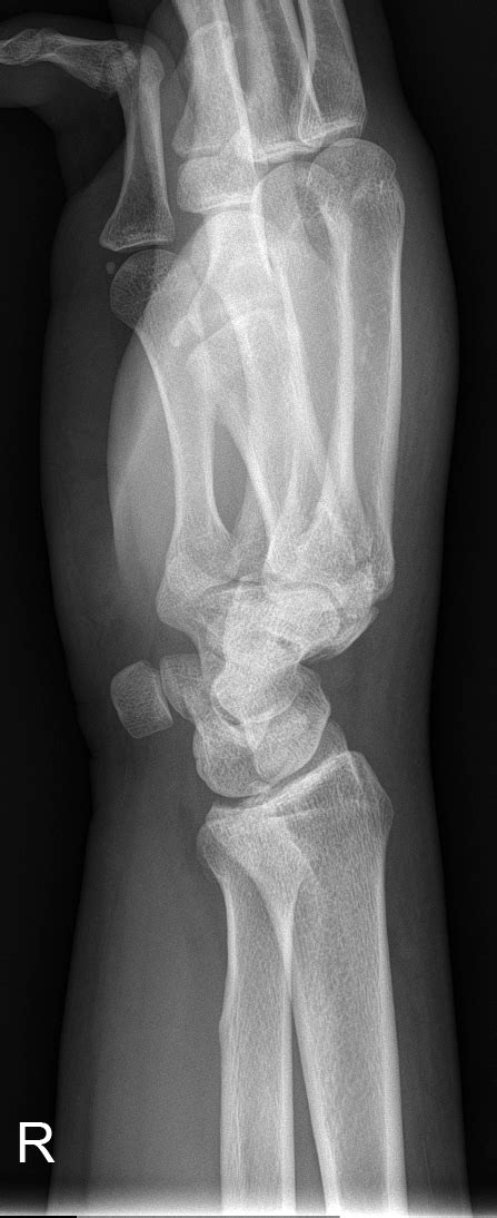 Imaging Hamate Fractures Wikiradiography