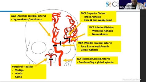 Stroke Territory Localization And Blood Vessel Supply Aca Grepmed