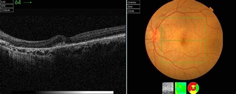 Pseudoxanthoma Elasticum Pxe Retina Image Bank