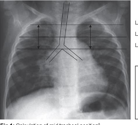 Endotracheal Tube Placement X Ray