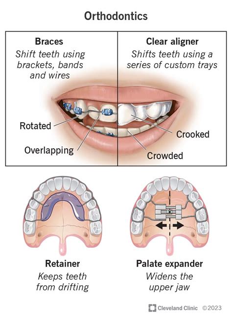 Orthodontic Treatment Clinic Cleveland Ohio Orthrodontic