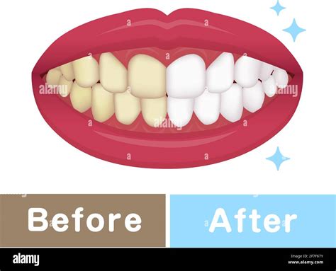 Teeth Whitening Vector Illustration Before And After Stock Vector