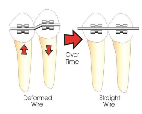 Braces And Orthodontics Your Dental Health Glen Dental