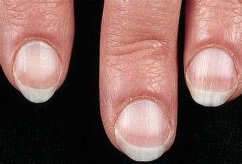What Your Fingernails Say About Your Health Passnownow