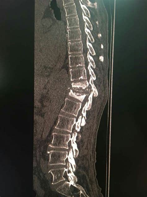 Most Probably Spinal Tb Potts Disease Anyway For Urgent Mri With