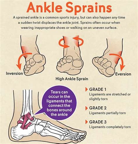 Ankle Sprain Causes Treatment And Prevention Reliva