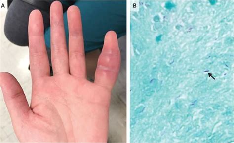 woman s swollen pinkie finger was rare sign of tuberculosis live science