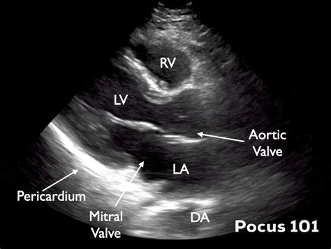 Measuring Cardiac Output With Echocardiography Made Easy Pocus 101 2023