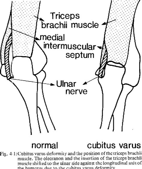 Figure 41 From Tardy Ulnar Nerve Palsy Caused By Cubitus Varus