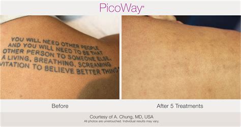 Laser Tattoo Removal Chicago Aesthetics Medspa