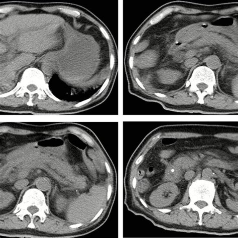 Abdominal Ct Scans At This Hospital On April 2 2018 Showing Liver