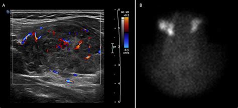 Case 1 Follow Up Thyroid Ultrasound A Shows Increased Vascularity