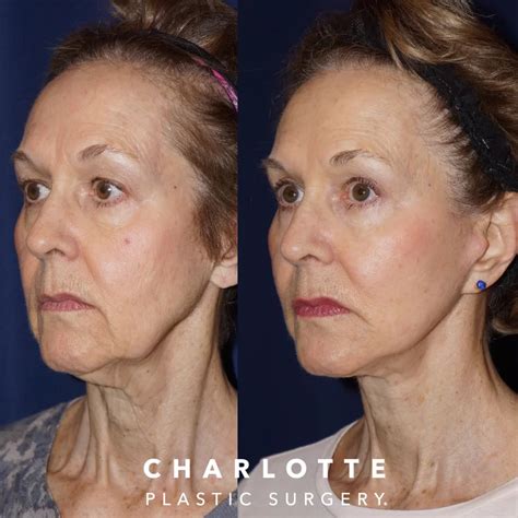 The Different Types Of Facelifts Which Technique Is Best For You