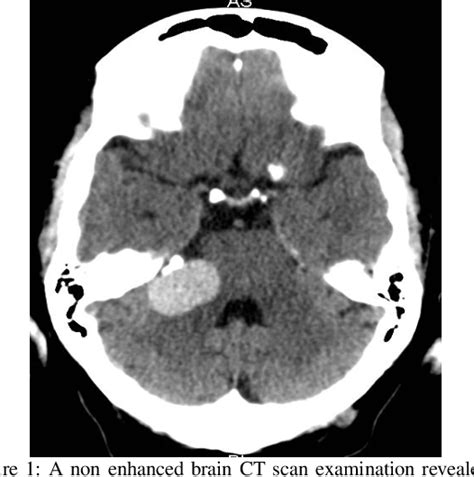 Figure 1 From Unusual Ct And Mri Appearance Of An Epidermoid Cyst A