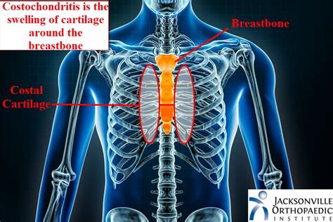 What Is Costochondritis Causes Symptoms And Treatment