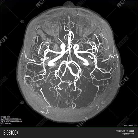 Mri Blood Vessels Image And Photo Free Trial Bigstock