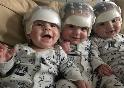 Adorable Us Triplets With Skull Deformity Overcome Rare Birth Defect
