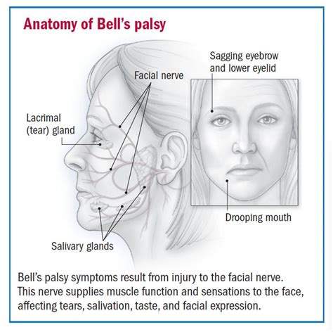 Bells Palsy Overview Harvard Health
