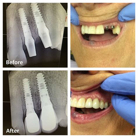 Single Tooth Dental Implant Ottawa Front Tooth Replacement