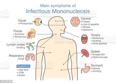 Symptômes De La Maladie De La Mononucléose Infectieuse Vecteurs Libres