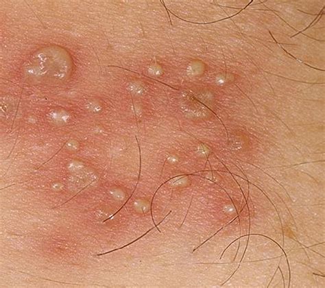 Sometimes this problem or pseudofolliculitis will give you give you large bumps or pimples with an abscess. Ingrown hair - Pictures, Treatment, Removal and Causes ...