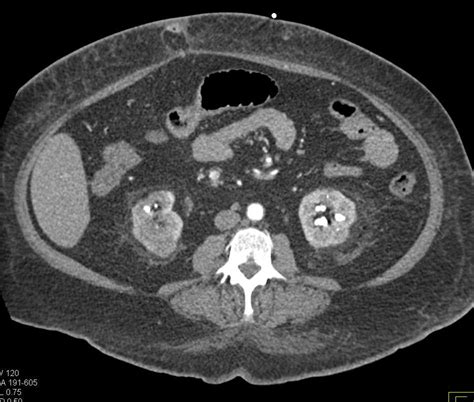 Small Bowel Perforation With Abscess And Renal Infarction Small Bowel
