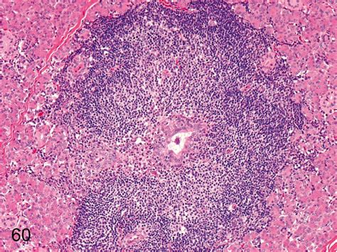 Salivary Gland Focal Inflammatory Cell Infiltration Focal Lymphocytic