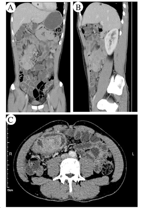Computed Tomography Ct Scan Of An Abdominal Mass Ct Showed A Mass