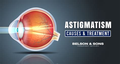 What Is Astigmatism Its Causes Symptoms And Treatment
